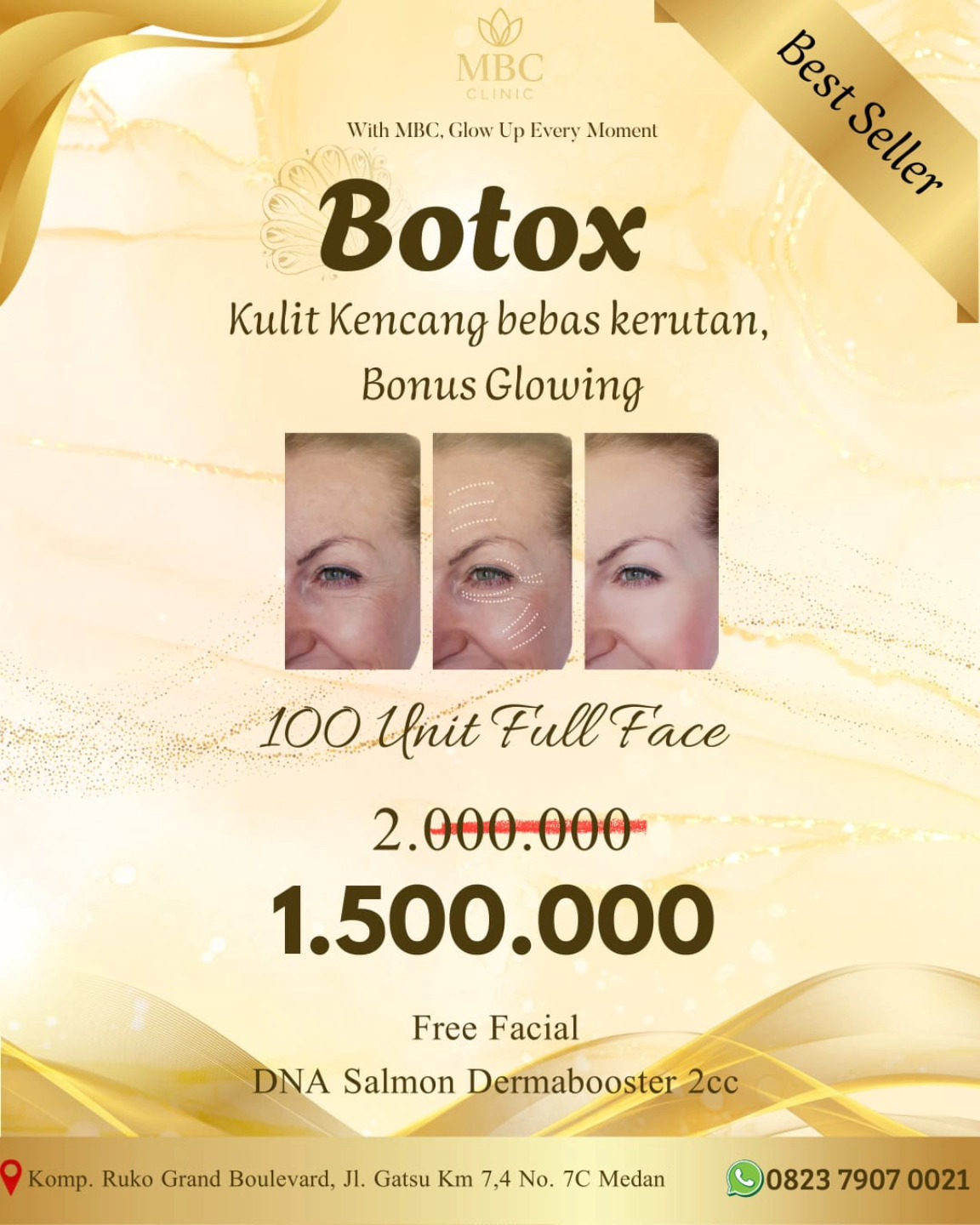 MBC - Waktunya tampil lebih muda & fresh Sekarang ada Promo Botox Full ...