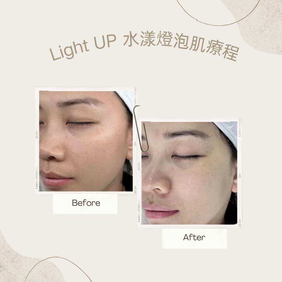 𝘿𝙚𝙚𝙧𝙫𝙞𝙡𝙡𝙚 - 【LightUP水漾燈泡肌療程💡】做一次效果已經好明顯，尤其是嘴邊圍住一直都有色素沉澱，所以做完之後除咗即時變白左之外 ...