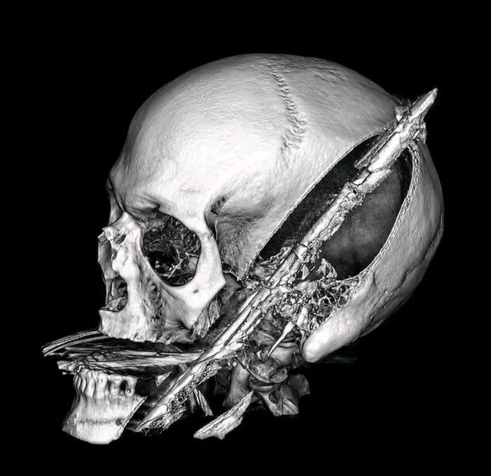 Orthopedics & Joint Replacement | A postoperative radiograph of the ...