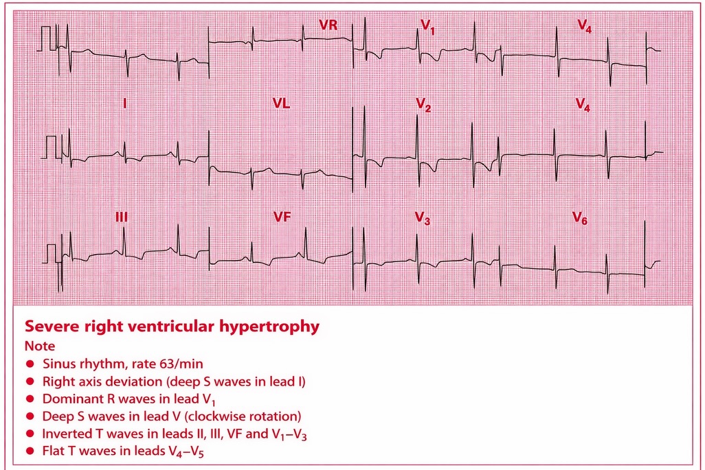 Echo Journey - Severe Right Ventricular Hypertrophy (RVH)... | Facebook