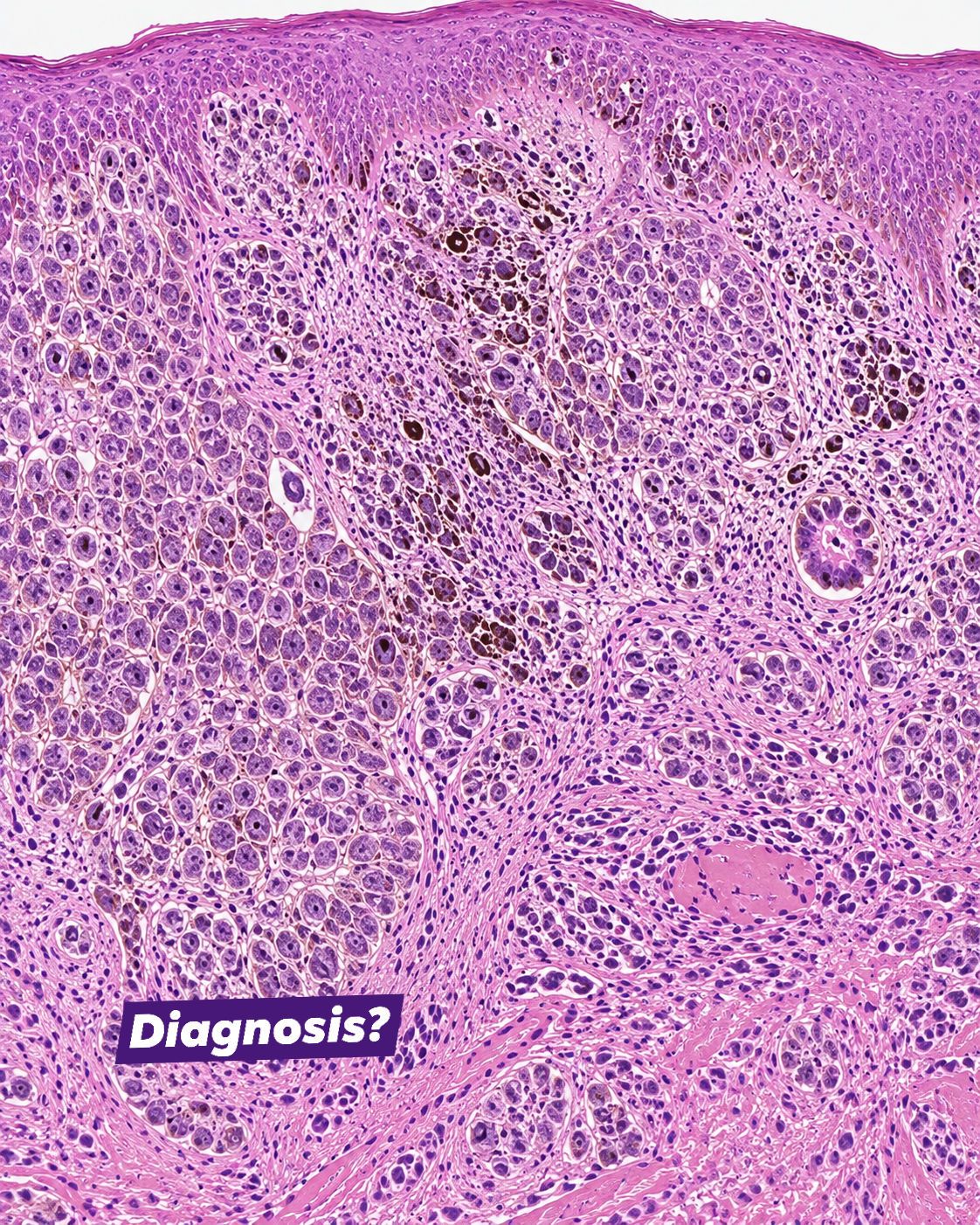melanotic macule pathology What is a on the labia? TEWL Flavour:Fruit Burst Terry Naturally Clinical Glutathione