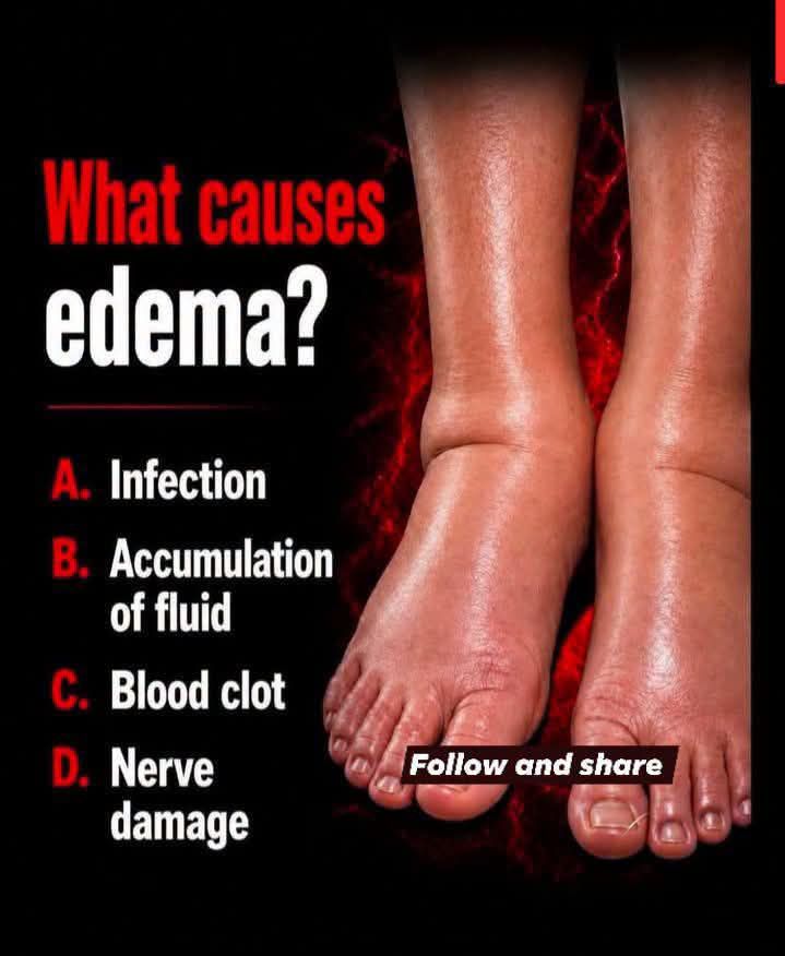 What could be causing sudden high blood pressure and leg swelling?