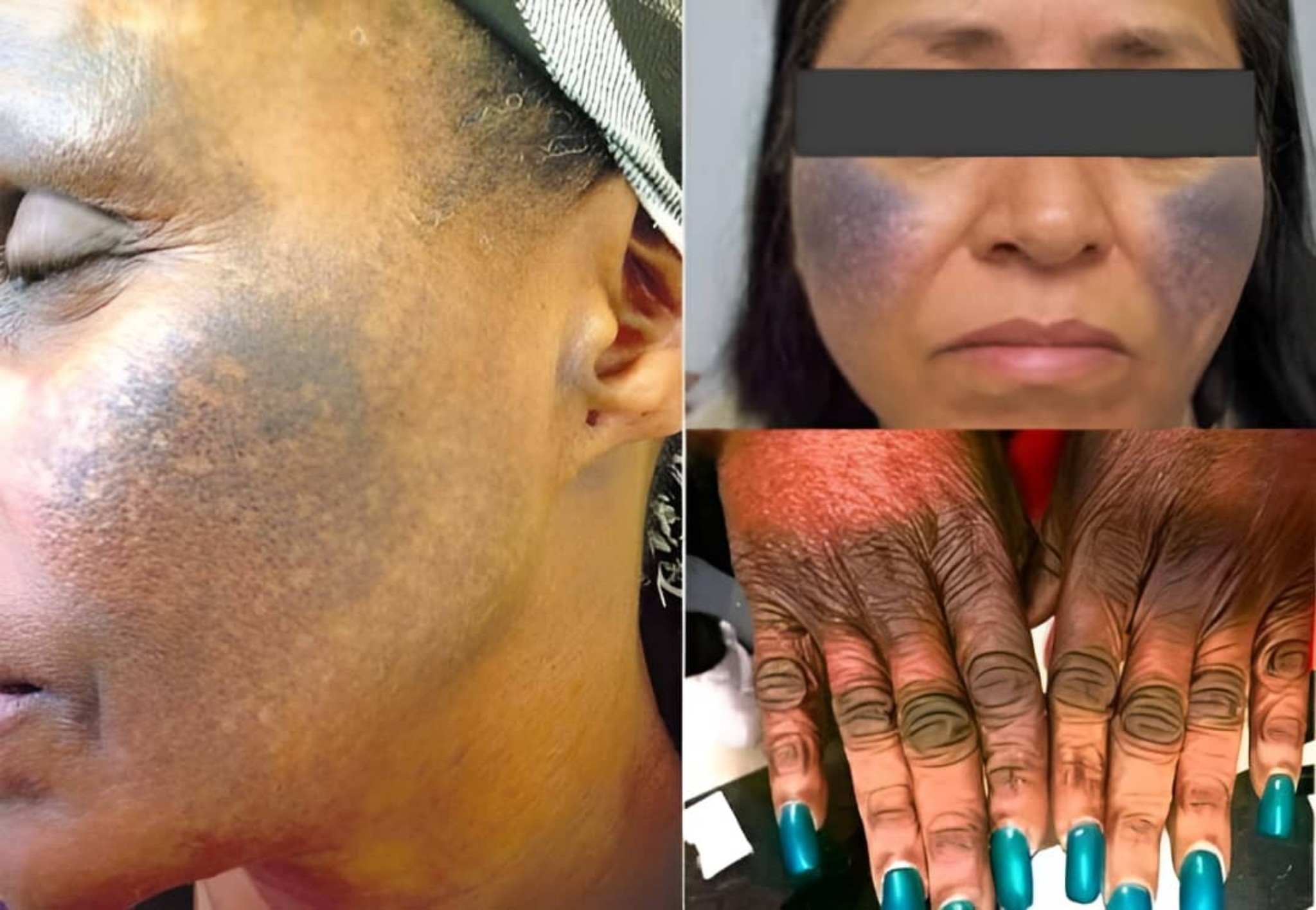 glutathion soap vs sun exposure Do skin whitening soaps provide only a temporary glow through exfoliation, or can they truly lighten skin in the long run? #skincareroutine #lifestyle Regulation of cardiac ferroptosis Peptide Complex Material:Orange