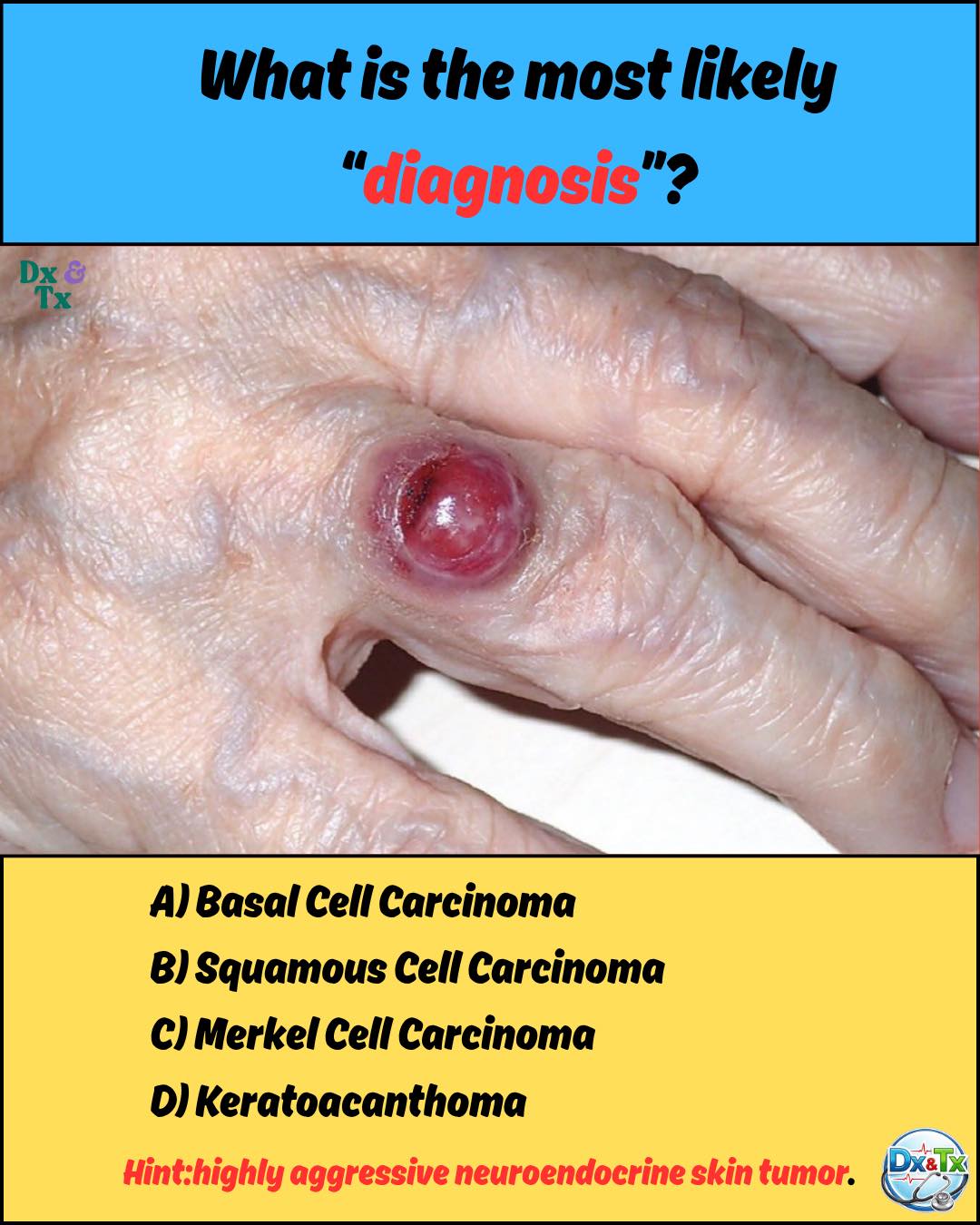 melanotic sarcoma is a skin cancer that begins with? A. a mole B. an ulcer C. lentigines D. miliaria rubra Ans: A