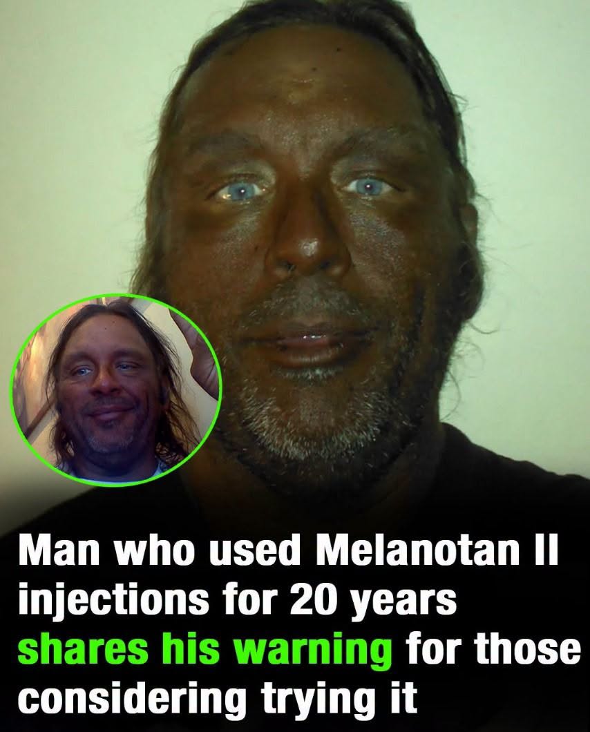 melanotan flashback He started taking II injections 17 years ago... and now he's sharing his warning .... 🥺😂😂 👇👇 promote thermogenesis Size:60 caps LOTUS DENTAL SKIN AND