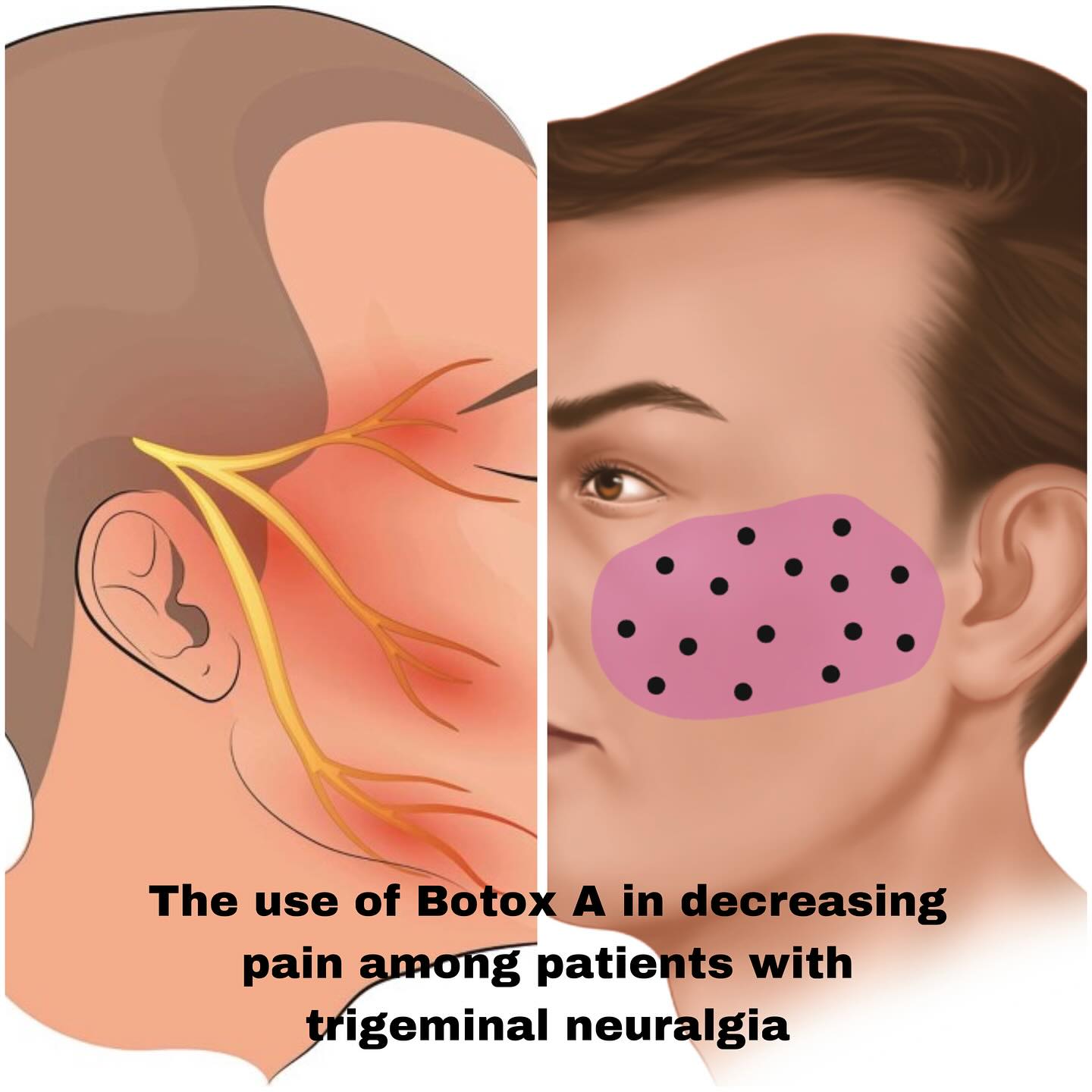b12 injections for trigeminal neuralgia Botox treatment pain support sensory wellness tablets Treatment:1 Month 5-amino-1mq subcutaneous dosing protocol