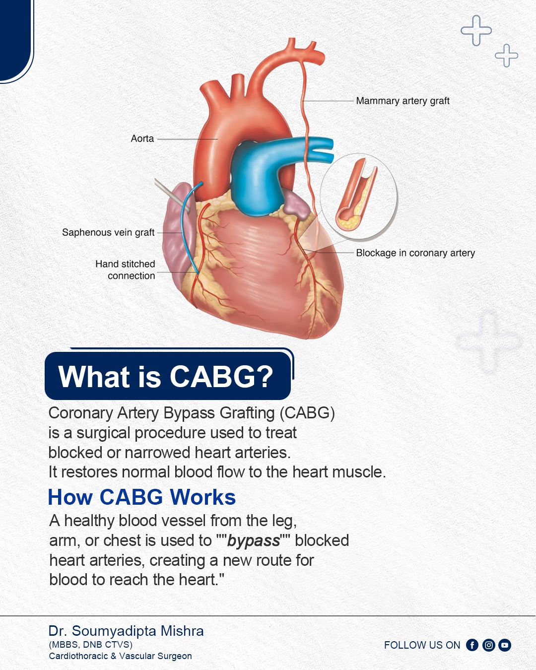 Understanding CABG (Coronary Artery Bypass Grafting) is crucial for ...