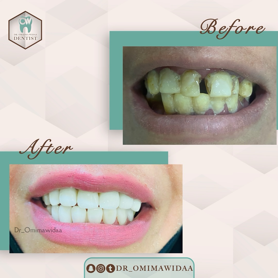 Dr_omaimawidaa - 🖇️📝 Case of the day : crowns & bridge 🦷 🔴patient ...