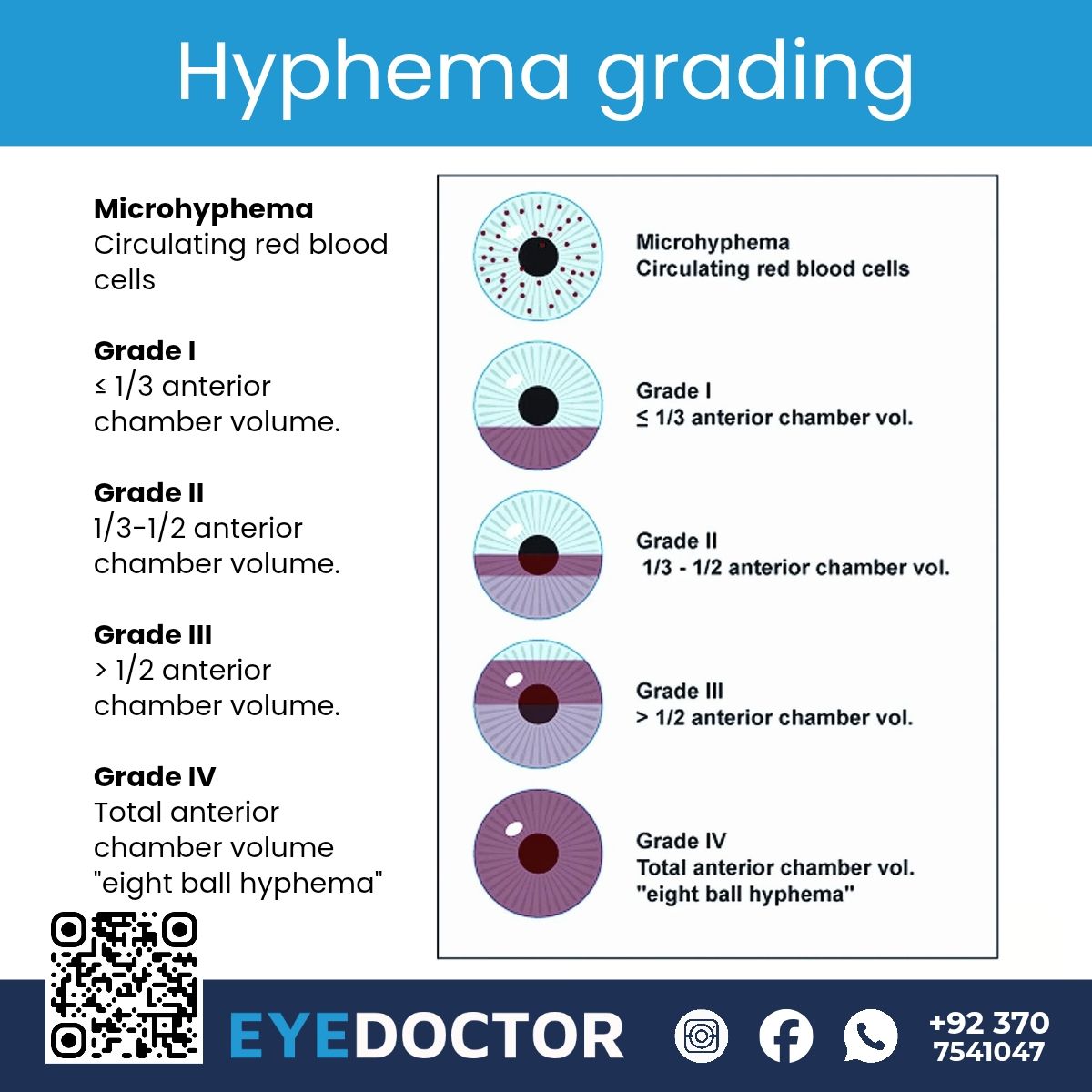 Students of optometry | Hyphema grading | Facebook