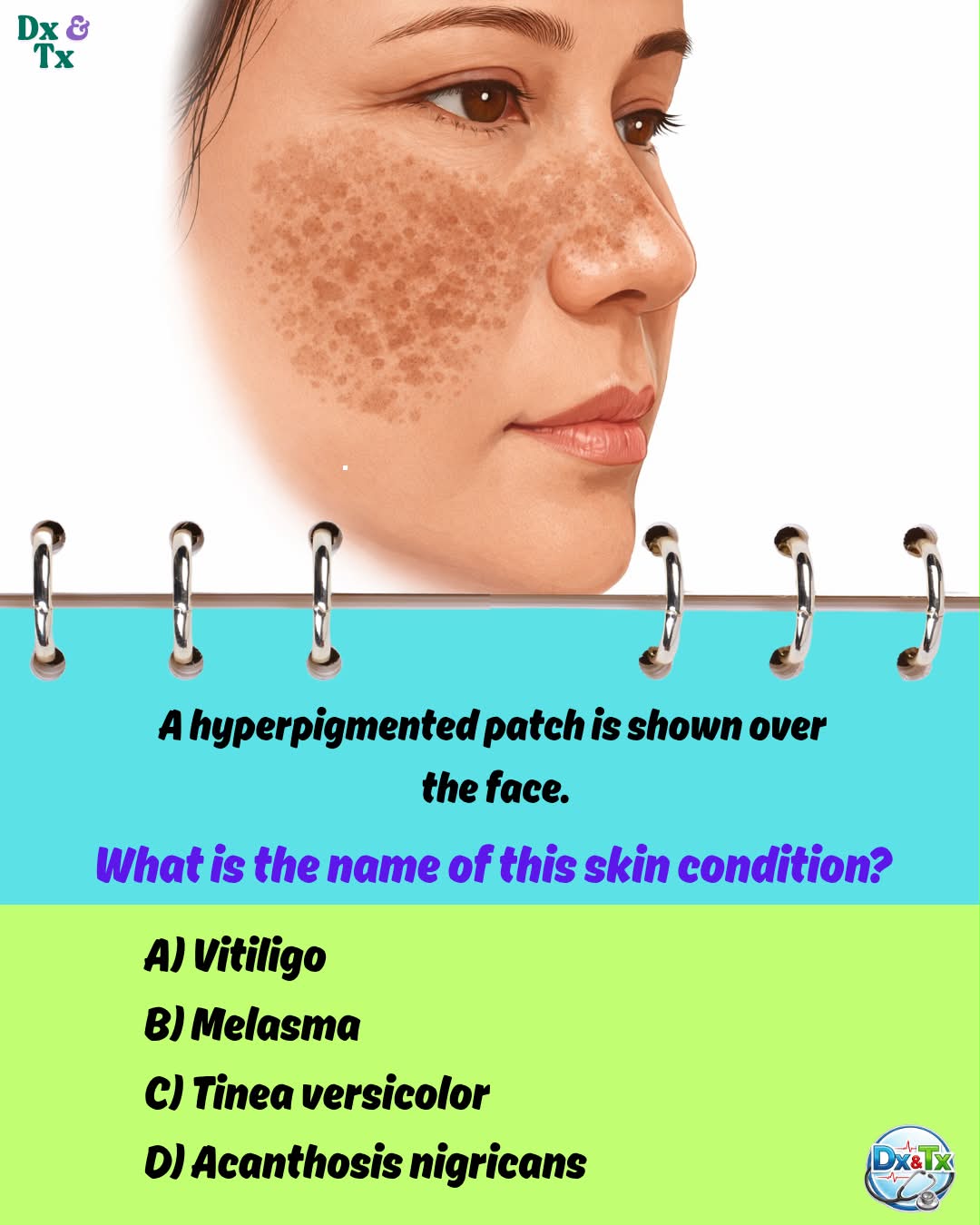 hutchinson's melanotic freckle treatment 12. freckle. Which of the following is not correct?a) Mostly occurs in the elderlyb) Mainly occurs in covered parts of the body c) Malignant d) Irregular bordere) Irregular colour (from Quantity:Single Unit Ladies Athletic bpc 157 for diverticulosis