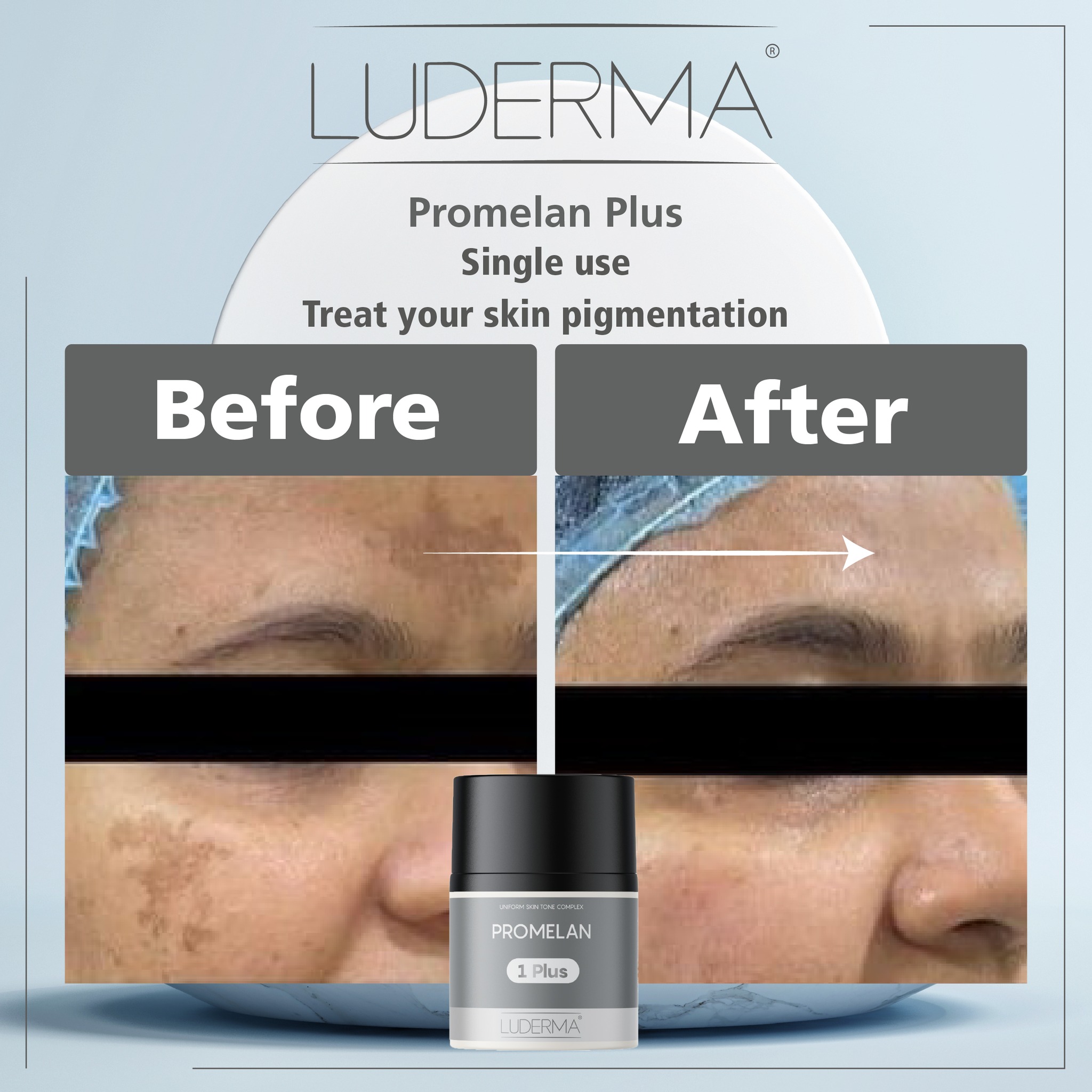 Luderma