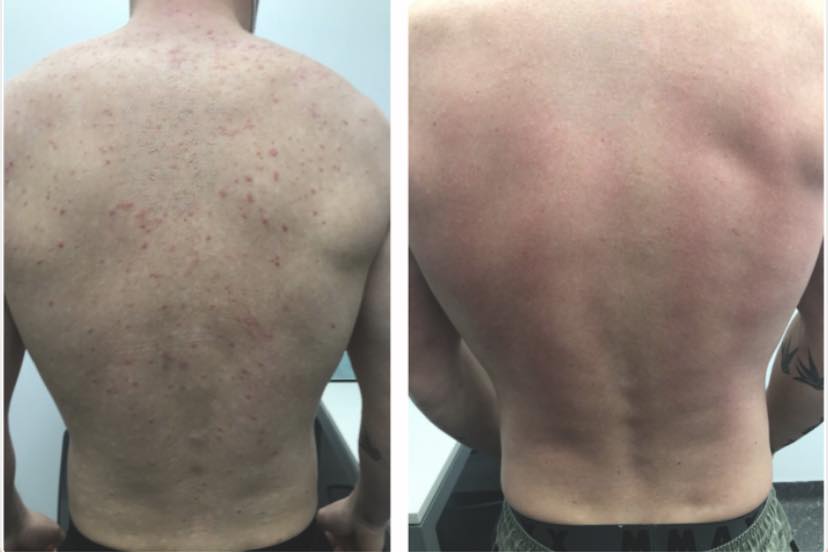 Did anyone try Glutathione IV for psoriasis treatment?