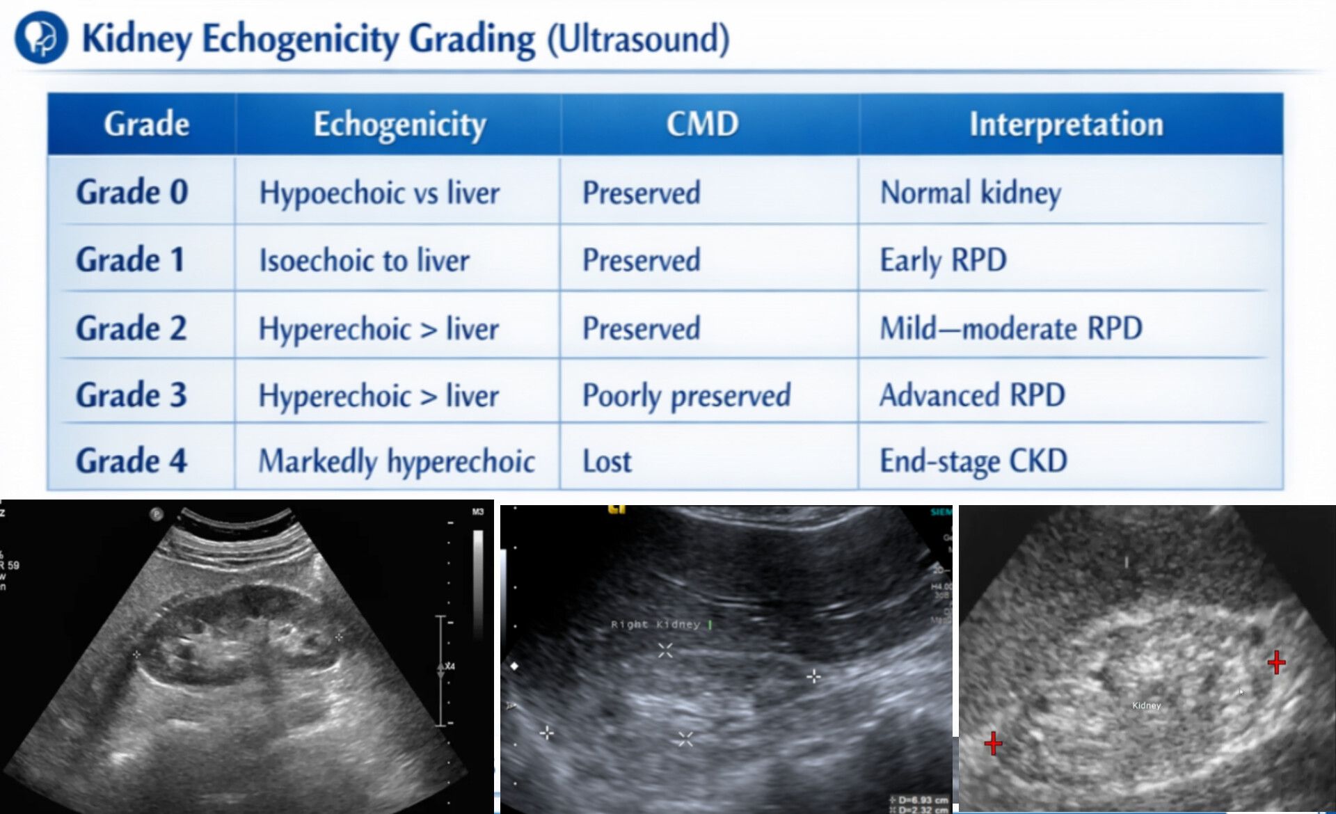 MEDICAL SONOLOGY | 🦋 Kidney Echogenicity Grading - Ultrasound | Facebook