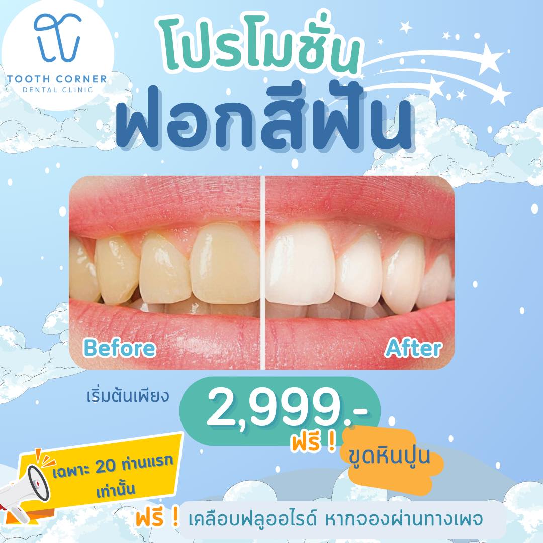⭐️⭐️คลินิกทันตกรรม Tooth corner ⭐️⭐️ 🎈🎈โปรโมชั่นฟอกสีฟัน 🎈🎈 เริ่มต้น ...
