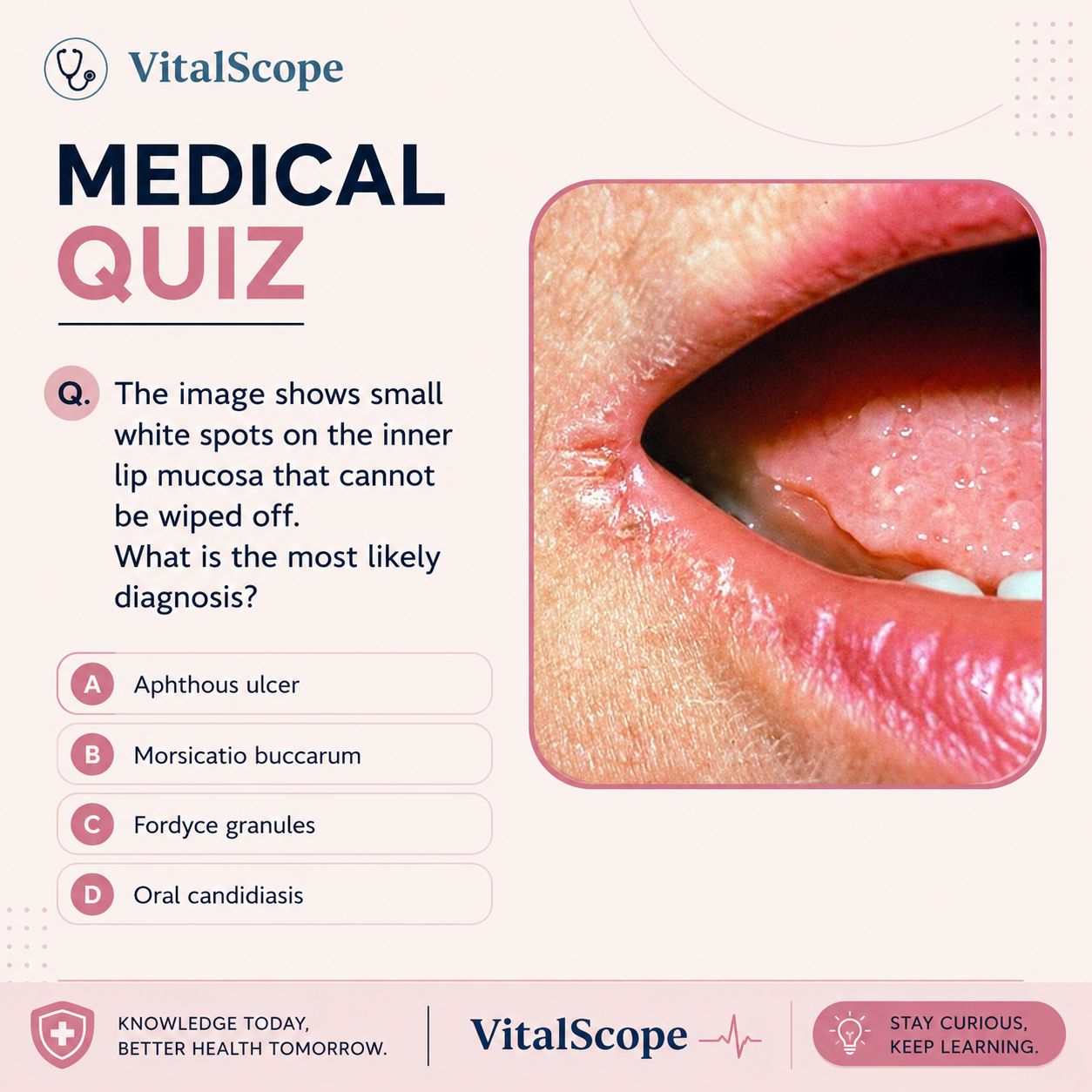 c on inside of lip 💡 How confident were you? Comment your answer before checking the explanation! Q. The image shows small white spots the inner mucosa that cannot be wiped off. What is the Mucocele