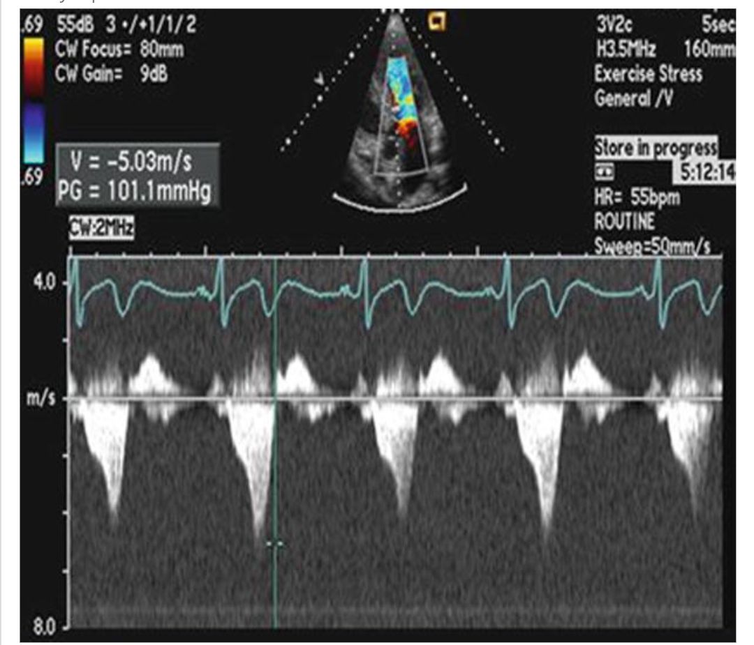Dr. - Difference of Drager shaped spectrum envelope in HOCM and ...