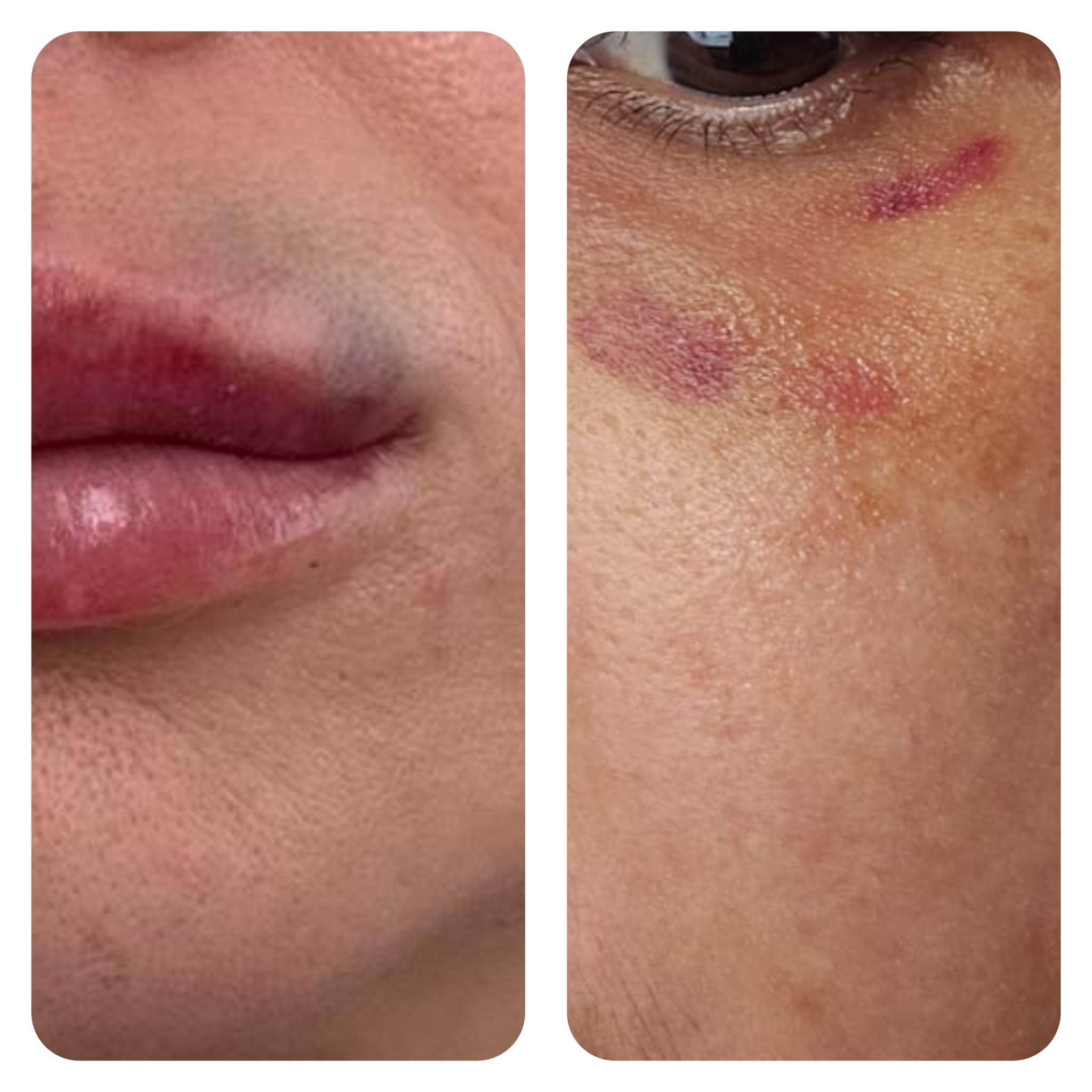bruise after semaglutide shot from injection site bruising? : r/Ozempic Bruising injections can be  Does Semaglutide Cause Bruising? Evidence