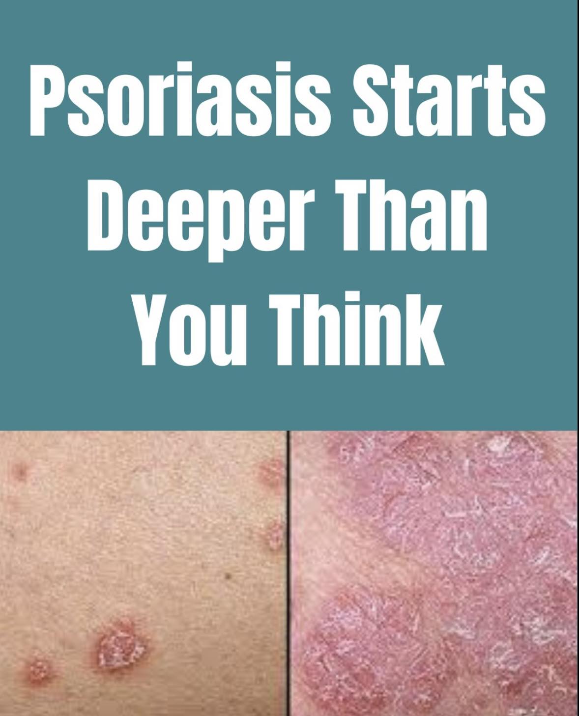 Linotar Gel 1 - Psoriasis Starts Deeper Than You Think 🔬... | Facebook