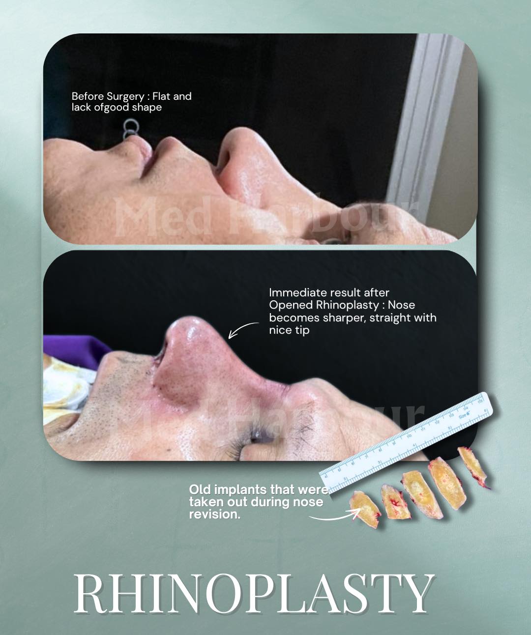 Medharbourthailand - OPENED RHINOPLASTY (Revision Case) 📅 Date: 2 July ...