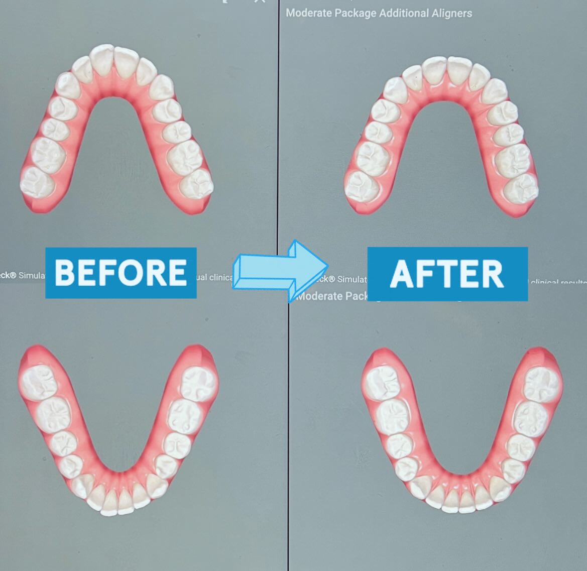 Mesolella - Invisalign: Before & After 5 Months of Clear Aligners 😀 Can ...