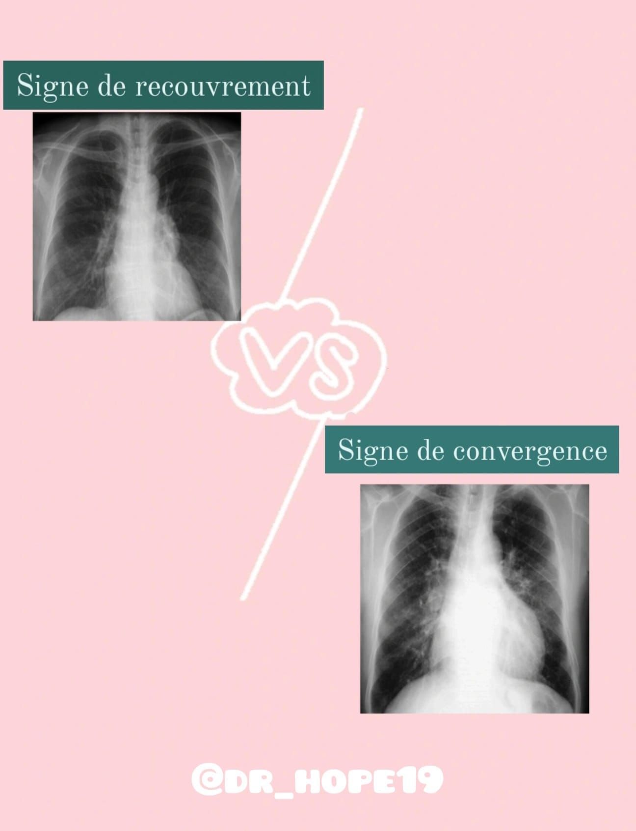 Dr hope - Signe de recouvrement VS signe de convergence... | Facebook