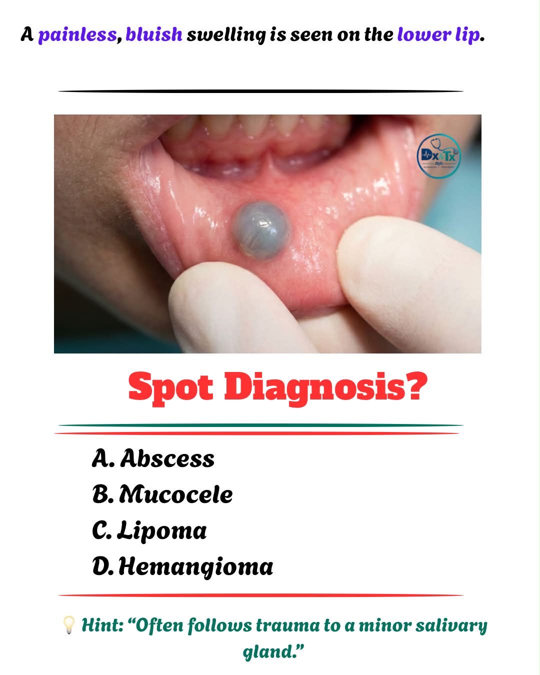 What is the diagnosis for a recurrent blue swelling on the lower lip?