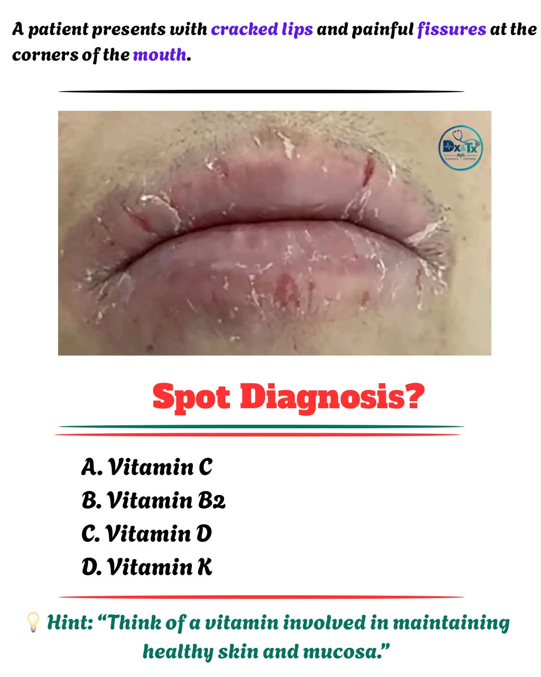 What vitamin deficiency causes cracked lips and painful fissures at the corners of the mouth?