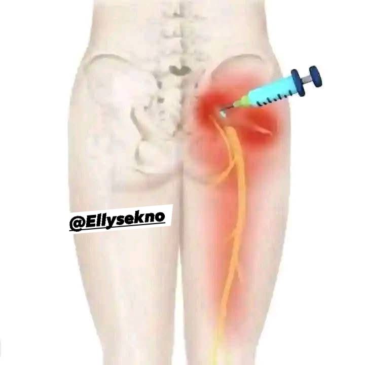 b12 injection in bum Buttock intramuscular risks and nerve damage What is the drug 50% Size:1000 mcg/ml - 1 box (10amp. x 1ml) -discount code N/A