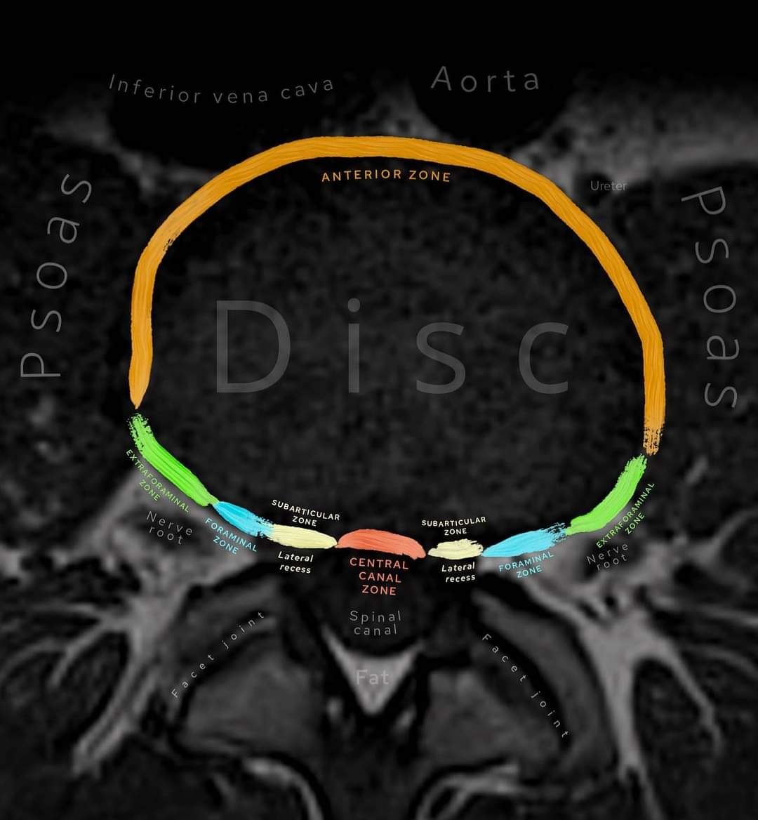 RADIOLOGY TIPS & TRICKS | #MRI #Spine ©️ Radiopedia | Facebook