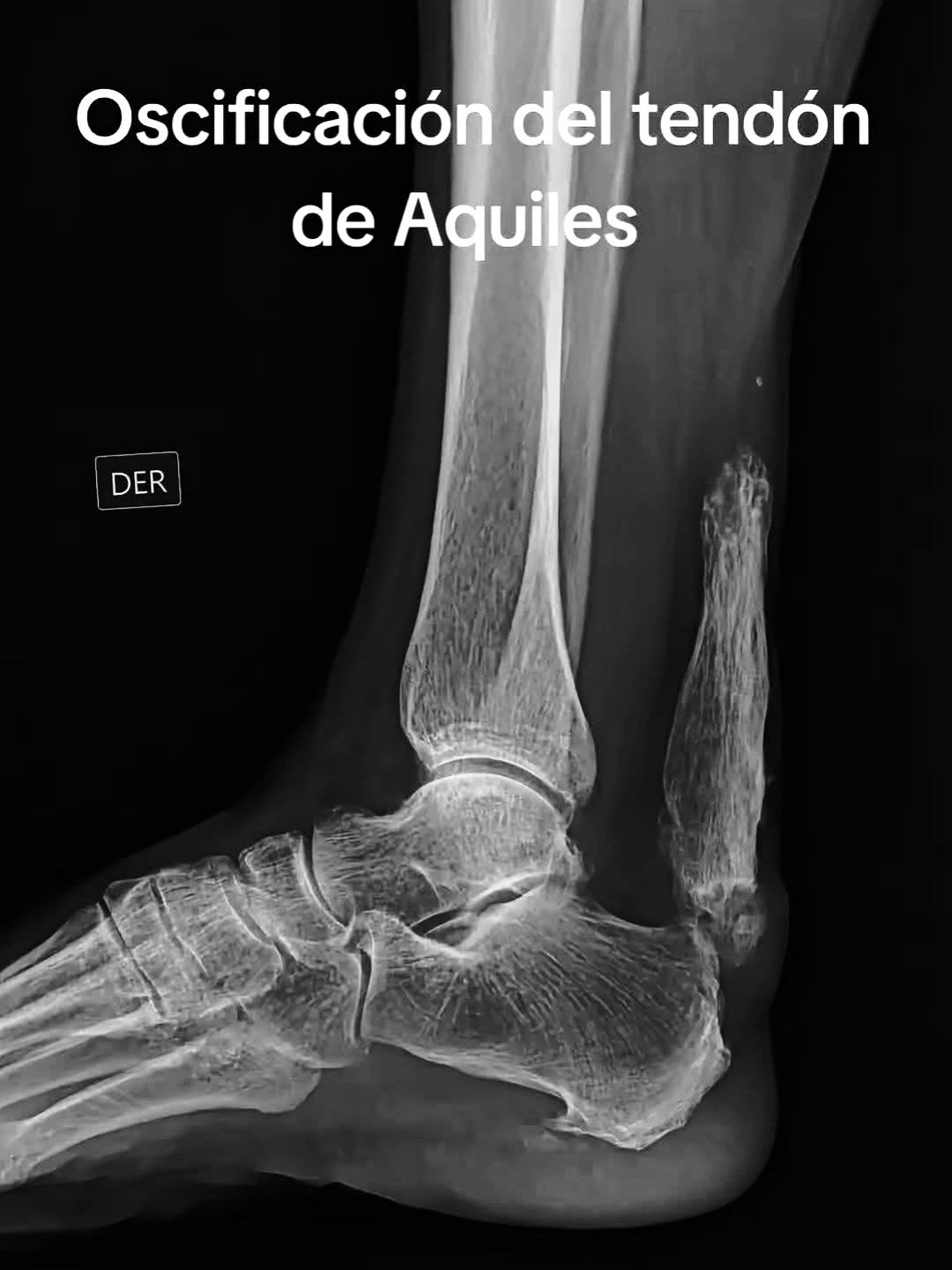 luis-qu-es-la-calcificaci-n-tendinosa-es-cuando-el-cuerpo-responde