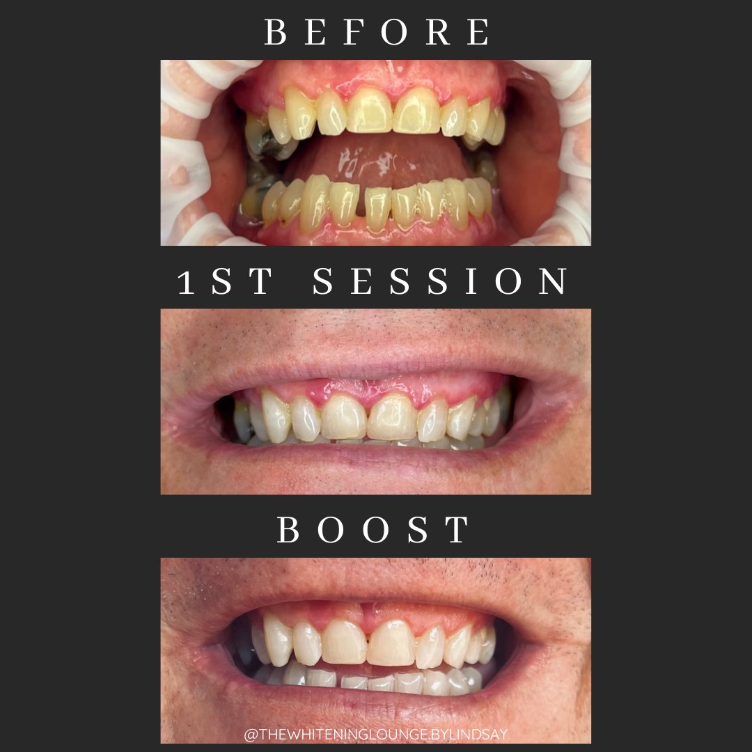 .. BOOST SESSION... - The Whitening Lounge By Lindsay