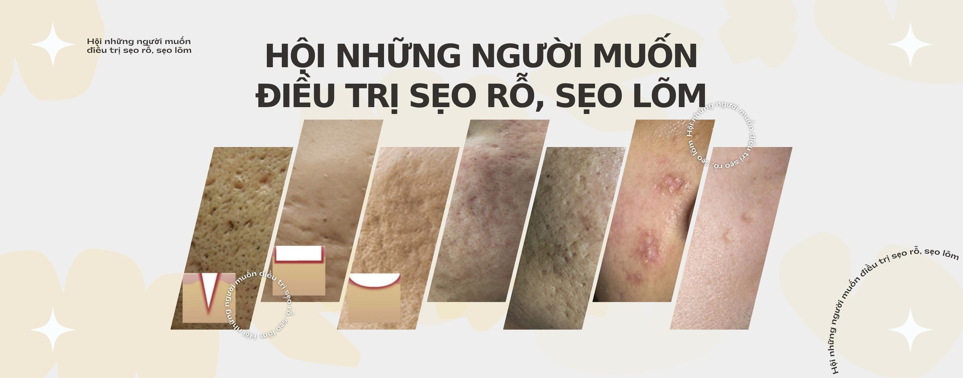 Hội những người muốn điều trị sẹo rỗ, sẹo lõm | Có chị em nào từng điều ...