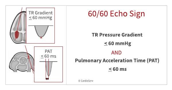 Heart Matters - 60/60 Echo Sign in Pulmonary Embolism | Facebook