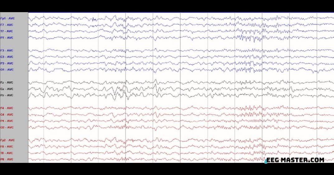 5 years child Both 14- and 6-Hz positive spikes are observed