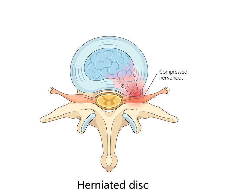 NextGen - Is Your Back Pain Caused by a Herniated Disc? Did you know ...