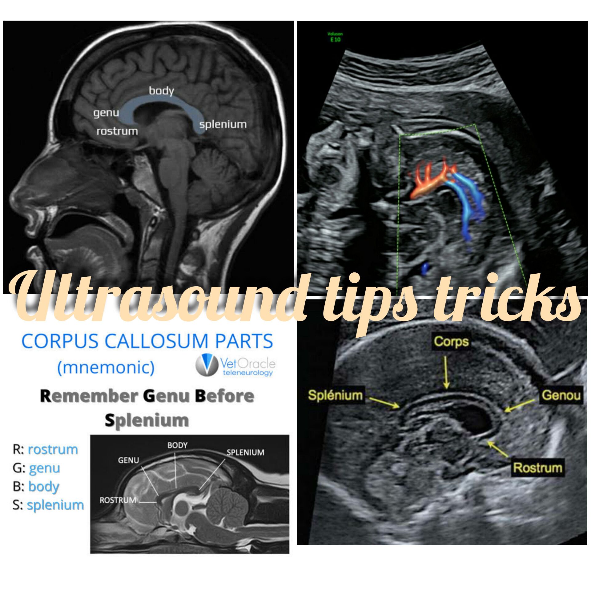 Ultrasound - The corpus callosal artery is identified branching from ...