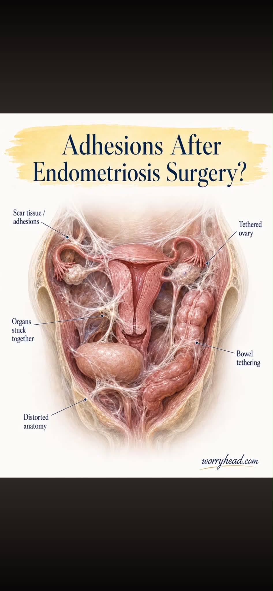 Who can help with abdominal adhesions after laproscopic surgery?