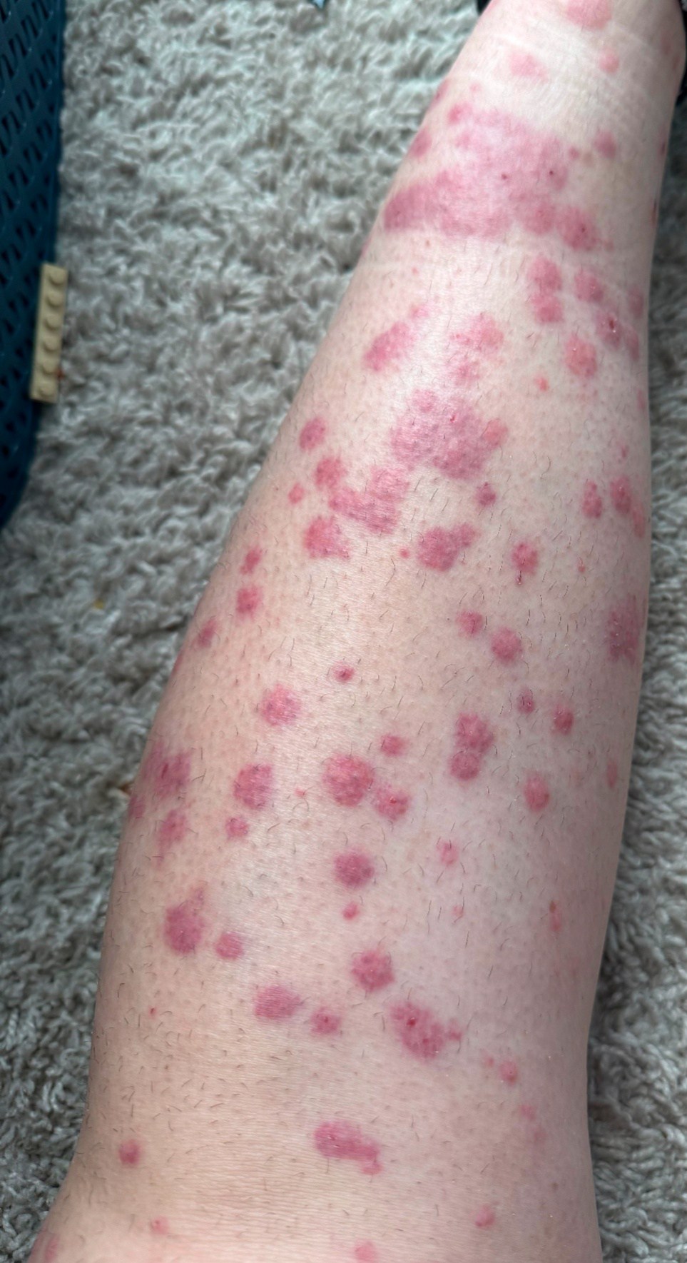 The Doctor's - Help! What kind of rash am I looking at?? Second time ...