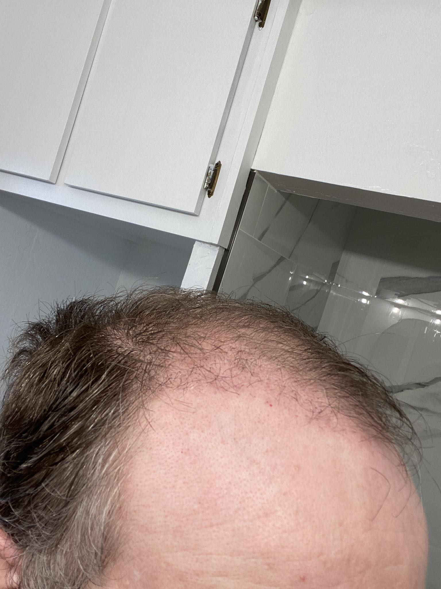 Hair growth progress 93 days after FUE transplant