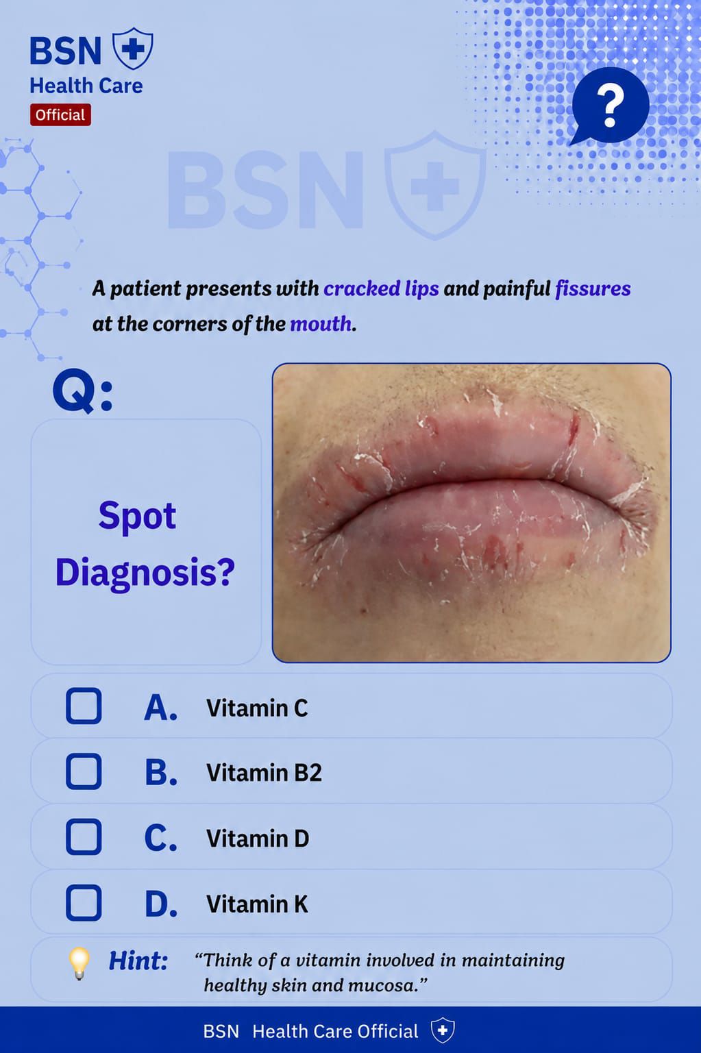 What vitamin deficiency causes cracked lips and painful fissures at the mouth corners?