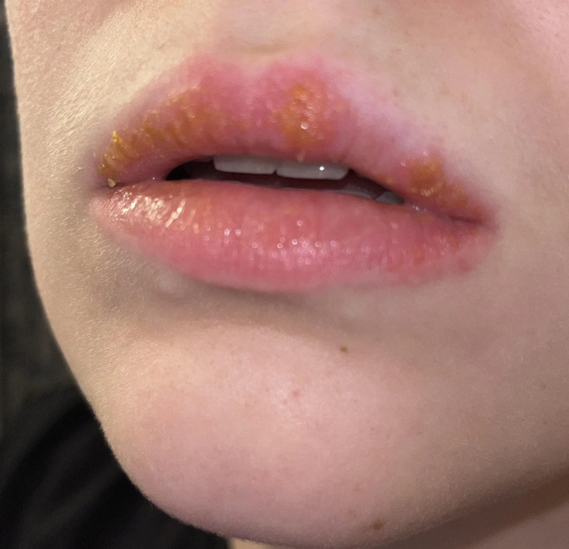 Can someone PLEASE tell me if this blister on her bottom lip is cause for concern?
