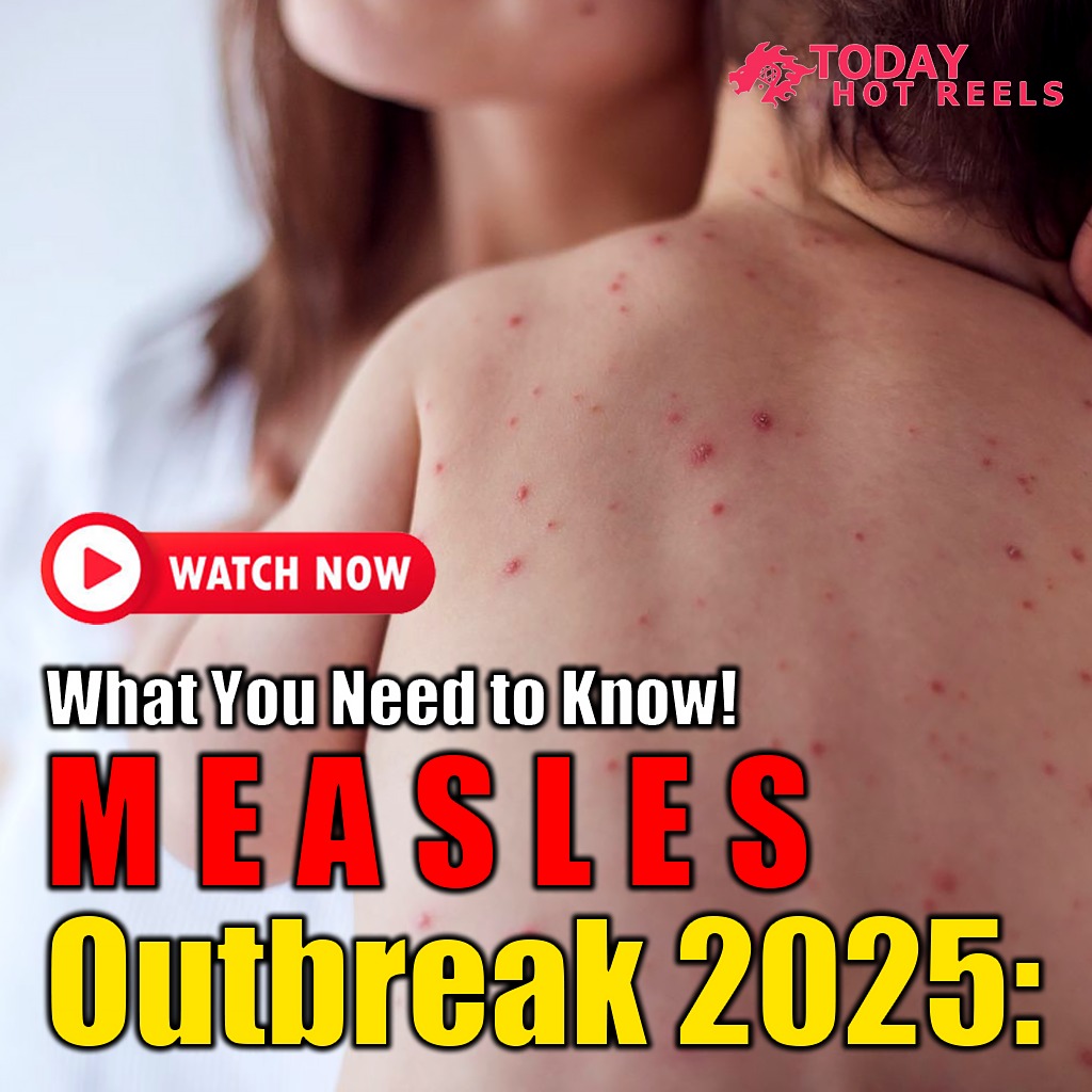 Today Hot Reels - Measles Outbreak 2025: What You Need to Know! https ...