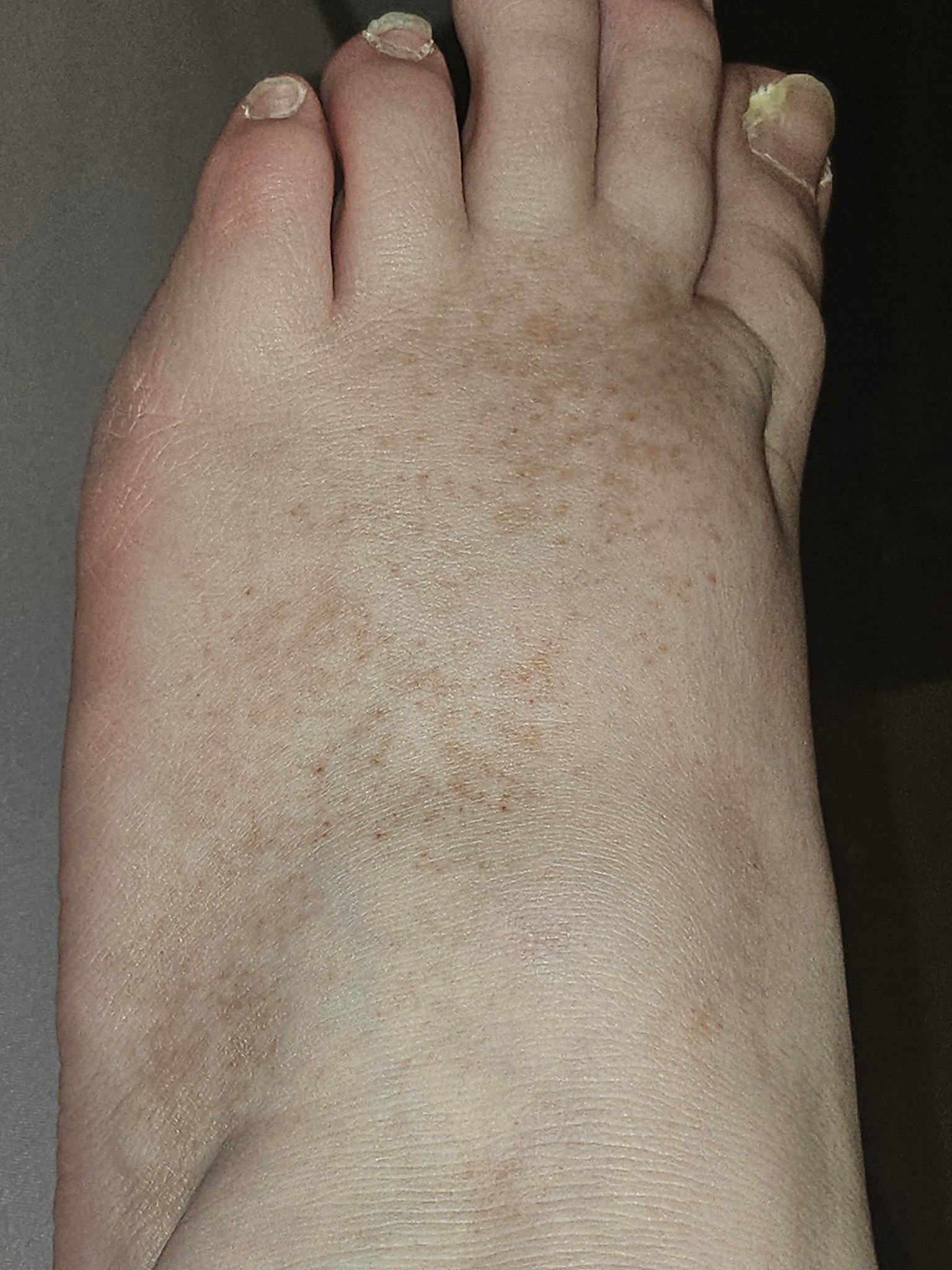 The Doctor's - Non-itchy spreading long-term discolouration/spotting on ...
