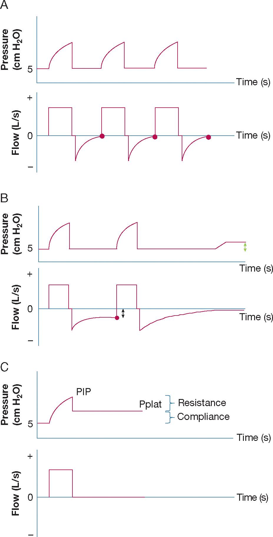 วิกฤติ-ฉุกเฉิน - 📉 Figure 3: อ่านกราฟช่วยชีวิต (Ventilator Waveforms ...