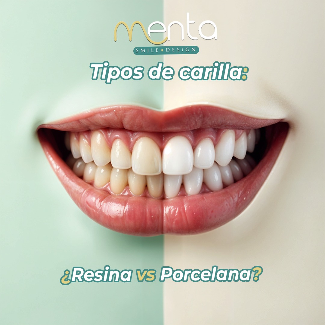 Menta - 🦷 Tipos de Carillas: Porcelana vs Resina ¿Estás pensando en ...