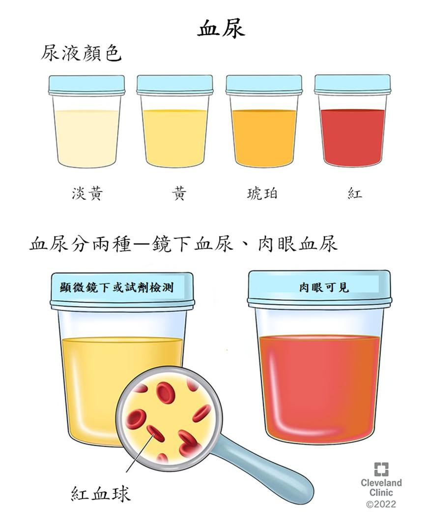 昭安泌尿科診所 - 永遠不要忽視血尿! ֎血尿(hematuria)可分類為兩種類型： 1. 肉眼血尿 2.... | Facebook