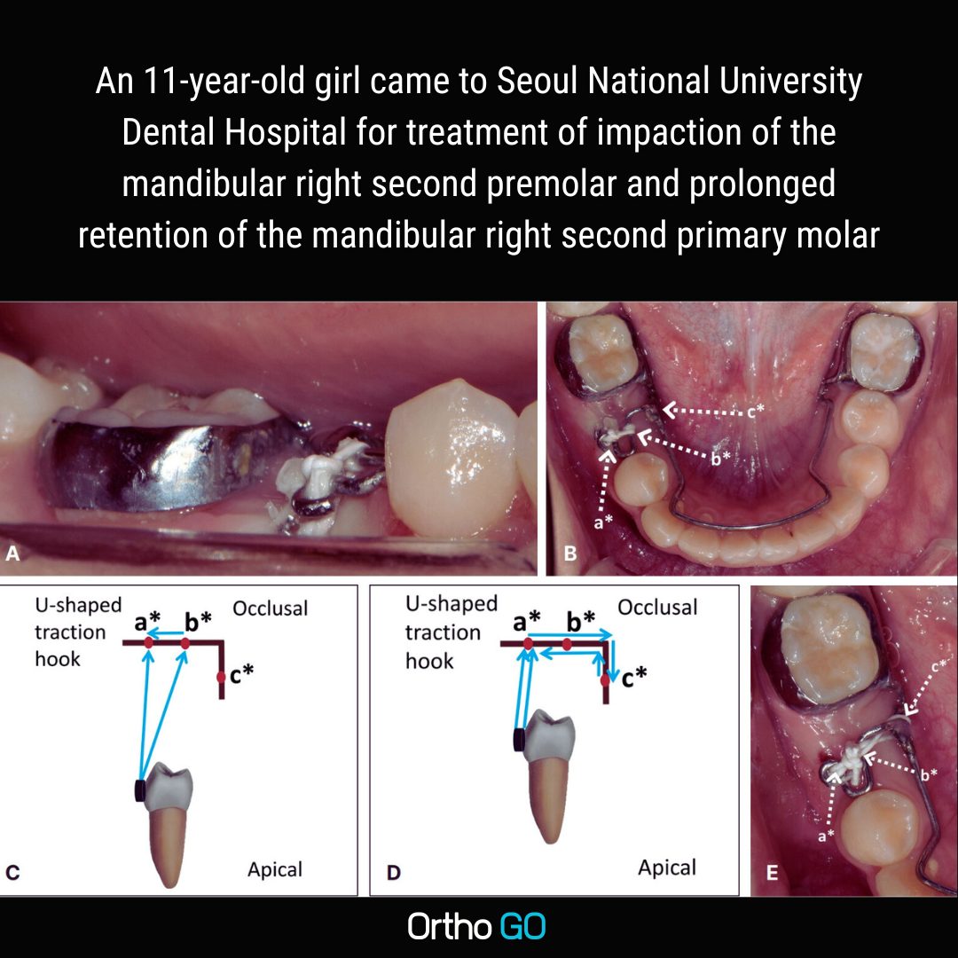 Ortho - 🔘 Intraoral photographs of a modified mandibular lingual arch ...