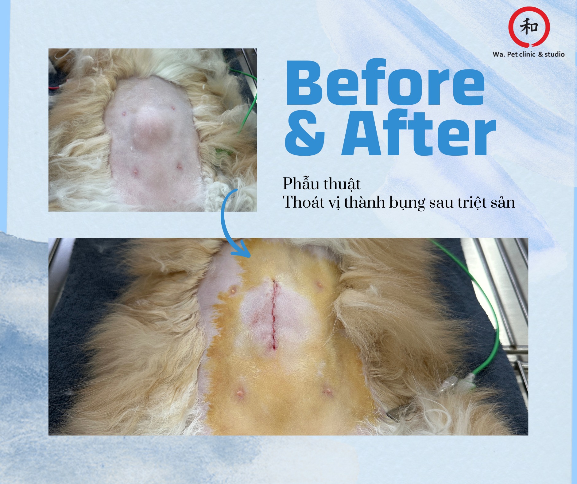 Wa. - 🩺 PHẪU THUẬT THOÁT VỊ THÀNH BỤNG SAU TRIỆT SẢN 🩺 📸 Before – After ...