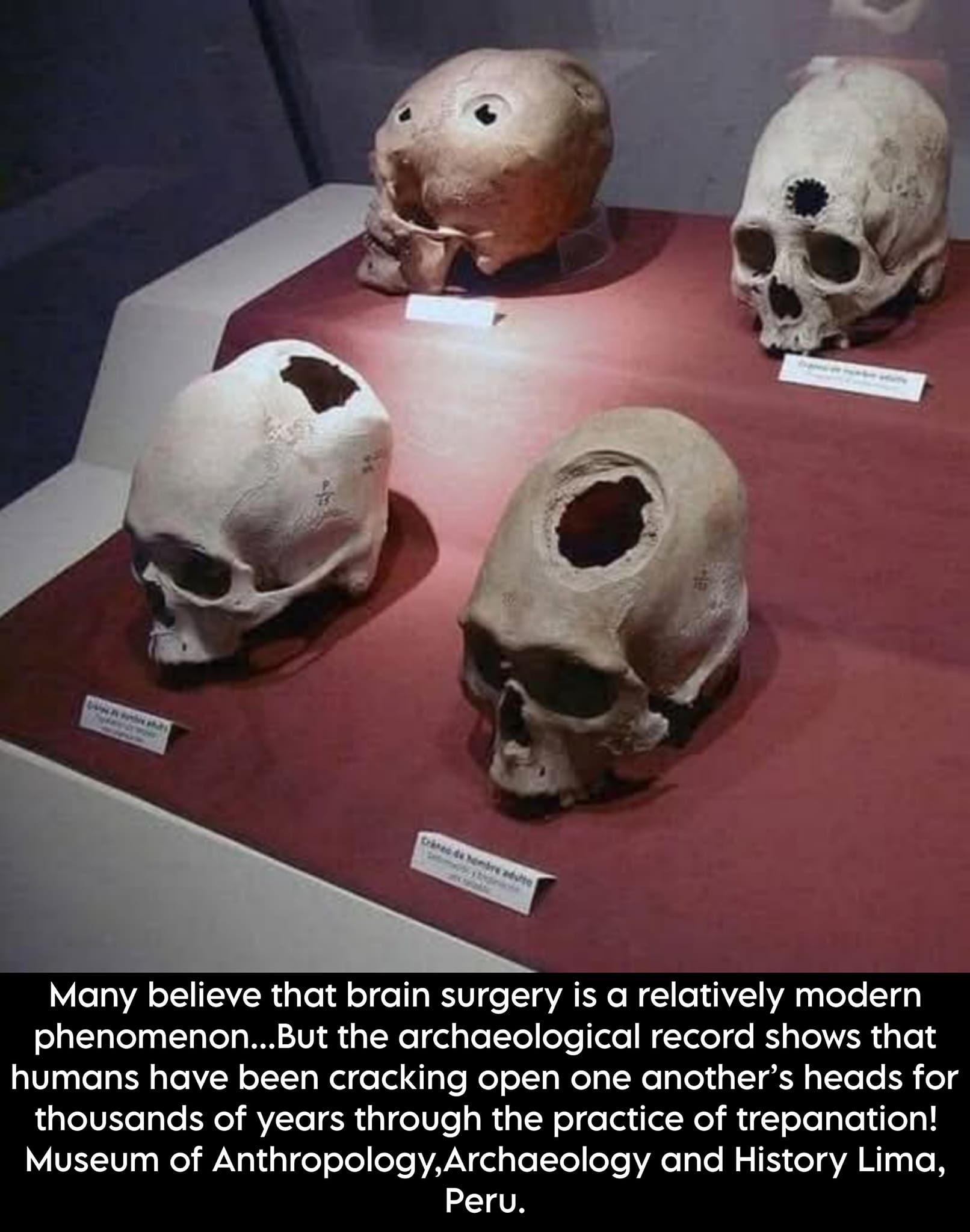 Trepanation, the ancient practice of drilling or cutting a hole in 