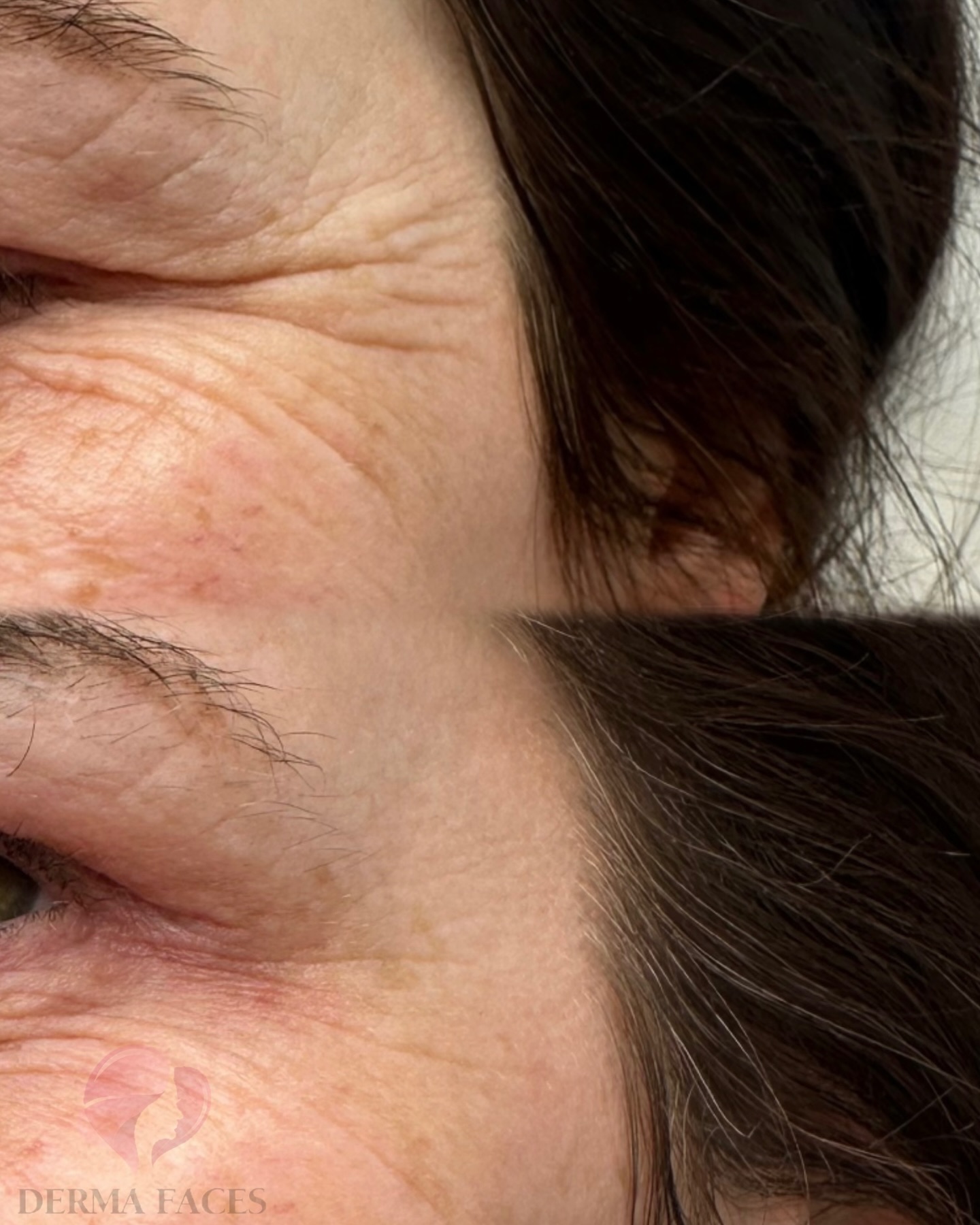Derma Faces